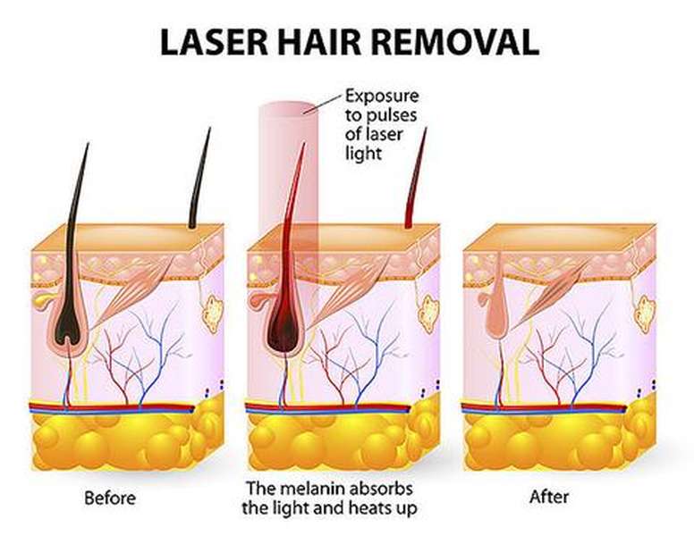 Laser hair removal device - Minihomy